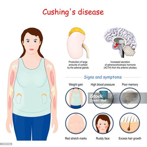 Signs of cushing - Cushing disease is hyperadrenocorticism caused by an ACTH-secreting tumor of the pituitary gland. Clinical signs include polyuria, polydipsia, alopecia, and muscle weakness. A low-dose dexamethasone suppression test is the preferred diagnostic test. Treatment options include medical therapy, radiation, and surgery. 